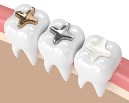 IMG-dental-fillings-GettyImages-925328752